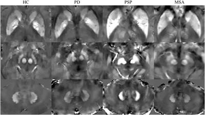 Quantitative susceptibility mapping and blood neurofilament light chain differentiate between parkinsonian disorders